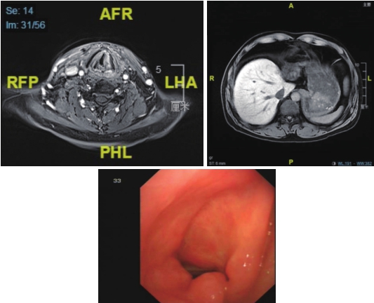 图5 喉MRI及腹部MRI（治疗结束后半年）